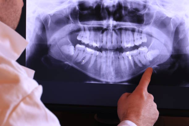 Best Emergency Wisdom Tooth Extraction in Golden Valley, AZ